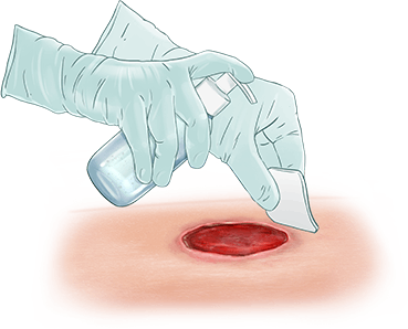 Wound Cleansing