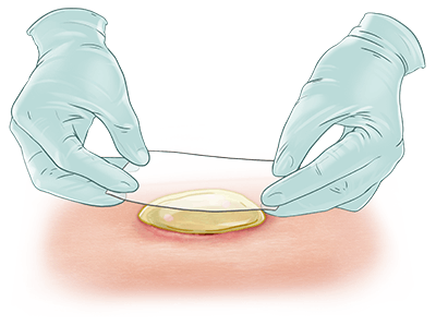 Wound Dressing