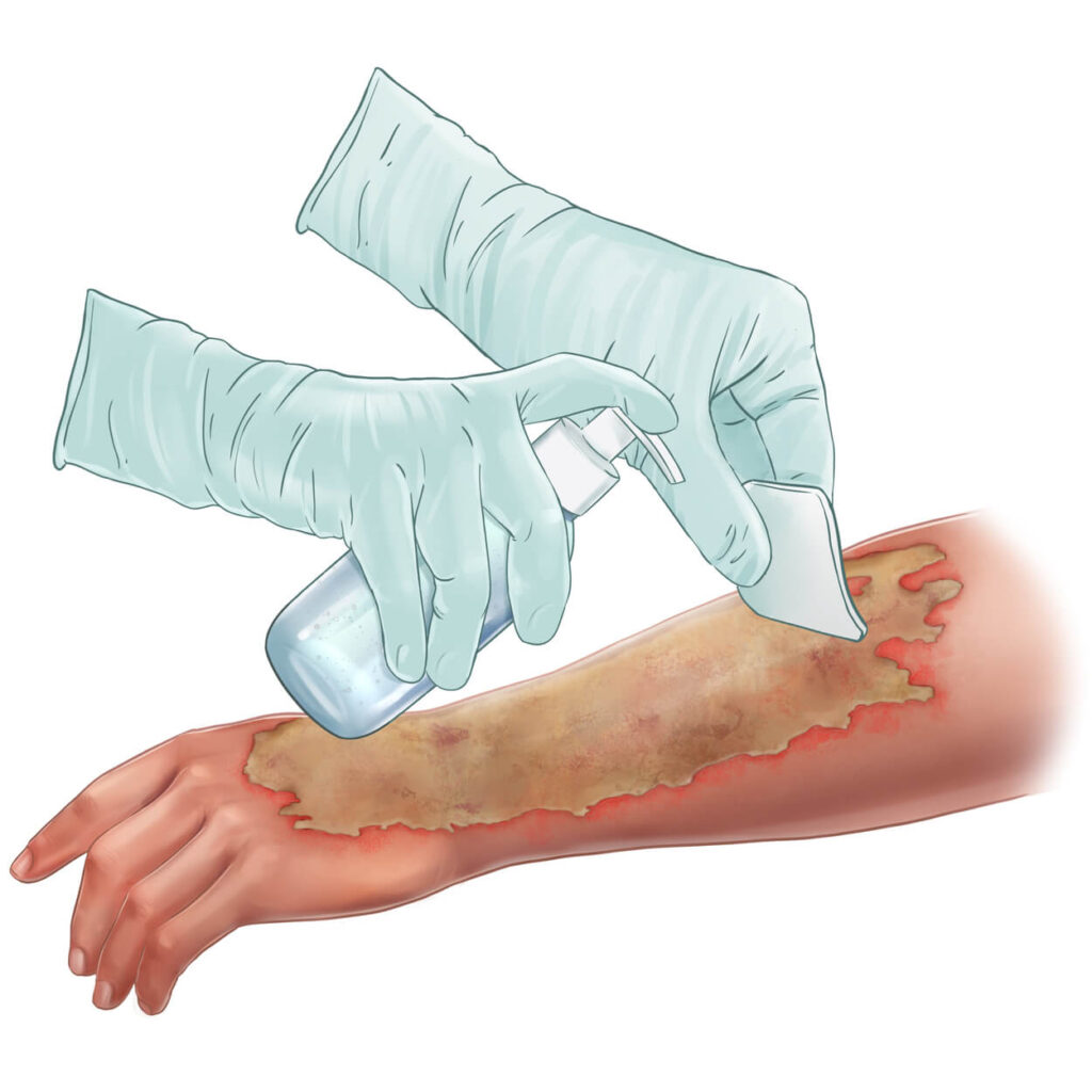 Wound Cleansing